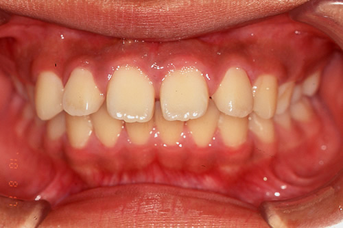 上顎前突（出っ歯)の治療例